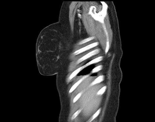 Chondrosarcoma - chest wall (Radiopaedia 65192-74199 B 54).jpg