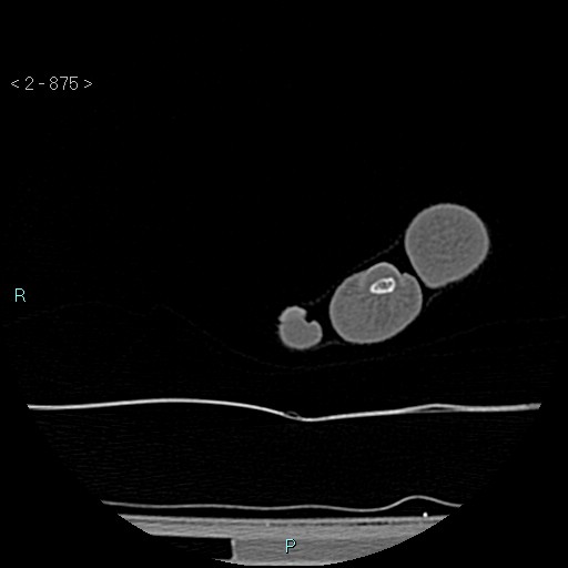 File:Chondrosarcoma - phalanx (Radiopaedia 69047-78812 Axial bone window 129).jpg