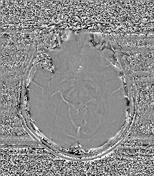 Chondrosarcoma - sphenoid wing (Radiopaedia 58259-67947 Axial SWI 34).jpg
