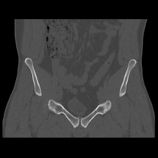 Chondrosarcoma of iliac wing (Radiopaedia 63861-72599 Coronal bone window 40).jpg