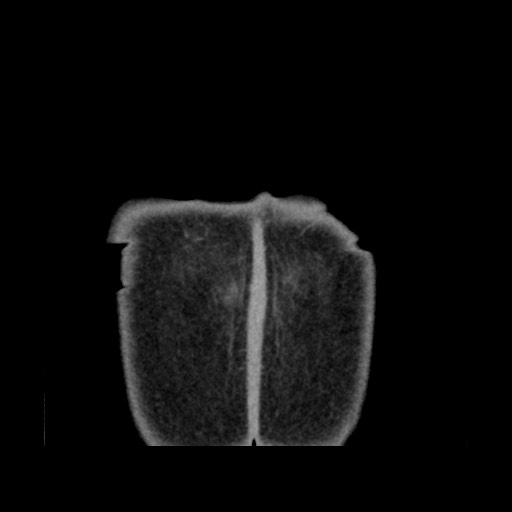 Chondrosarcoma of iliac wing (Radiopaedia 63861-72599 Coronal non-contrast 114).jpg
