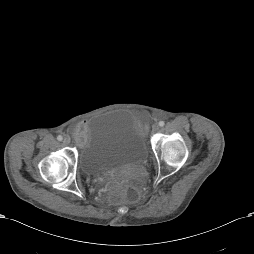Chondrosarcoma of the spine (Radiopaedia 49871-55143 A 59).jpg