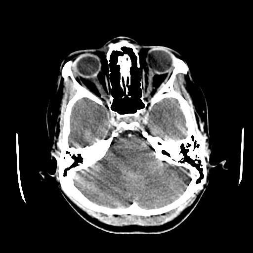 File:Choriocarcinoma of ovary with cerebral and pulmonary metastases (Radiopaedia 25983-26118 C+ arterial phase 36).jpg