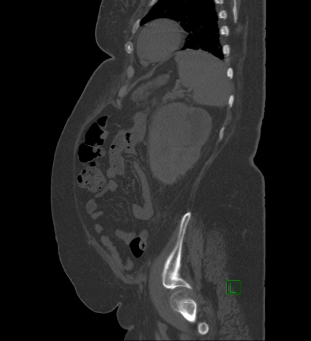 Chromophobe renal cell carcinoma (Radiopaedia 84239-99519 Sagittal bone window 23).jpg