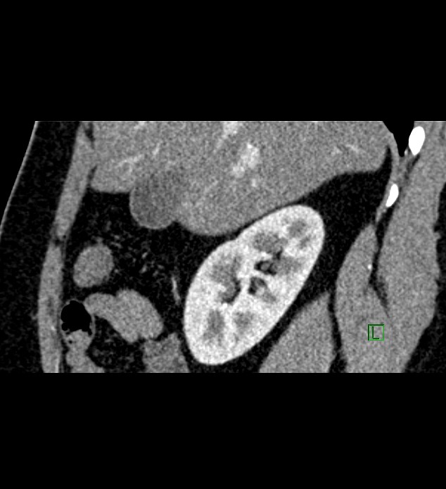 Chromophobe renal cell carcinoma (Radiopaedia 84286-99573 F 123).jpg