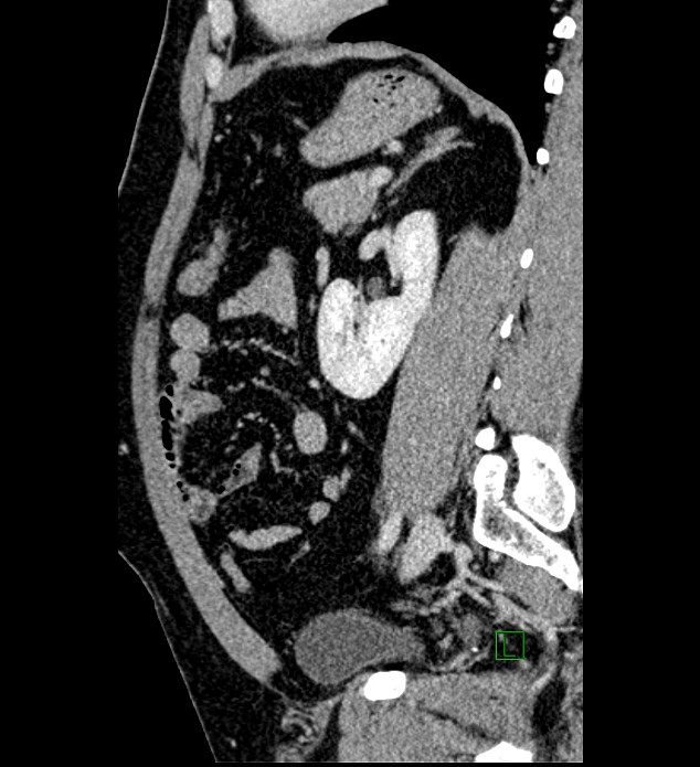 Chromophobe renal cell carcinoma (Radiopaedia 84286-99573 I 63).jpg