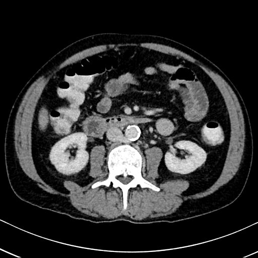 Chronic appendicitis complicated by appendicular abscess, pylephlebitis and liver abscess (Radiopaedia 54483-60700 B 77).jpg