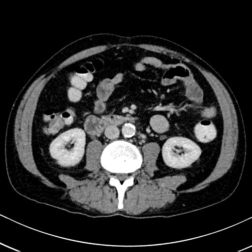 Chronic appendicitis complicated by appendicular abscess, pylephlebitis and liver abscess (Radiopaedia 54483-60700 B 80).jpg
