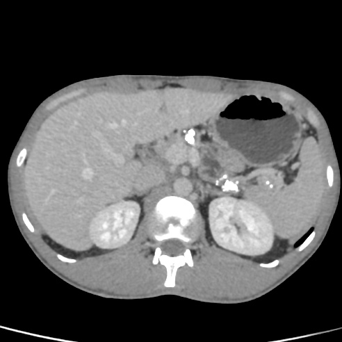 File:Chronic calcific pancreatitis (Radiopaedia 56280-62953 C 11).jpg
