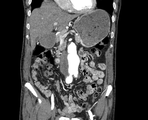 Chronic contained rupture of abdominal aortic aneurysm with extensive erosion of the vertebral bodies (Radiopaedia 55450-61901 D 20).jpg