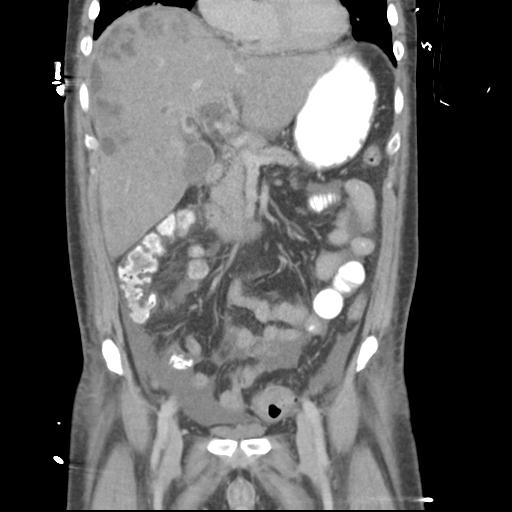 Chronic diverticulitis complicated by hepatic abscess and portal vein thrombosis (Radiopaedia 30301-30938 B 25).jpg