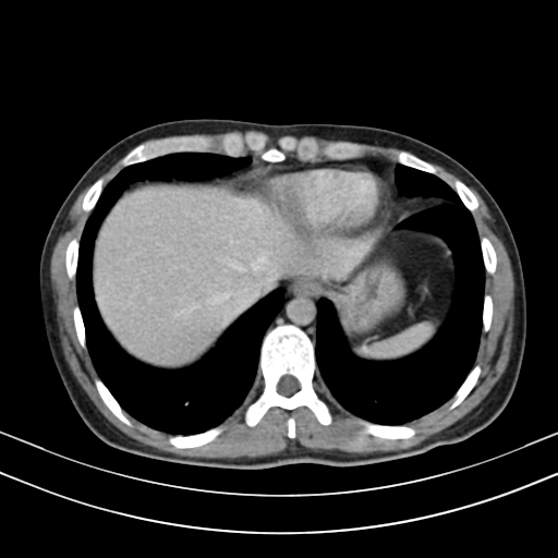 Chronic eosinophilic pneumonia (Radiopaedia 39331-41587 Axial C+ delayed 87).png