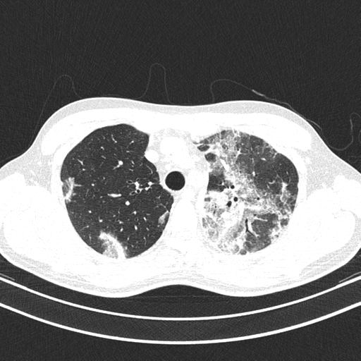 File:Chronic eosinophilic pneumonia (Radiopaedia 39331-41587 Axial lung window 13).png