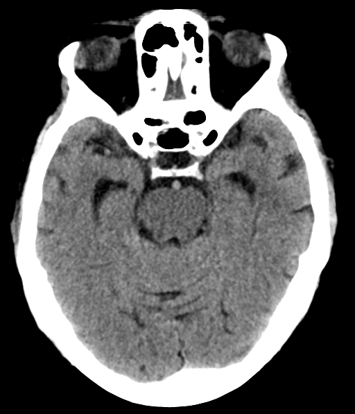 File:Chronic hypertensive encephalopathy (Radiopaedia 39993-42485 Axial non-contrast 13).png