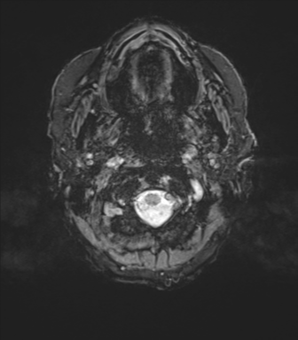 Chronic hypertensive encephalopathy (Radiopaedia 72844-83495 Axial SWI magnitude 2).png