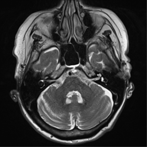 File:Chronic hypertensive encephalopathy (Radiopaedia 72844-83495 Axial T2 9).png