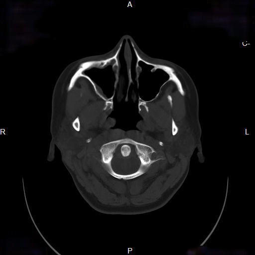 File:Chronic maxillary sinusitis with a foreign body (dental filling material) (Radiopaedia 7811-8639 Axial bone window 6).jpg