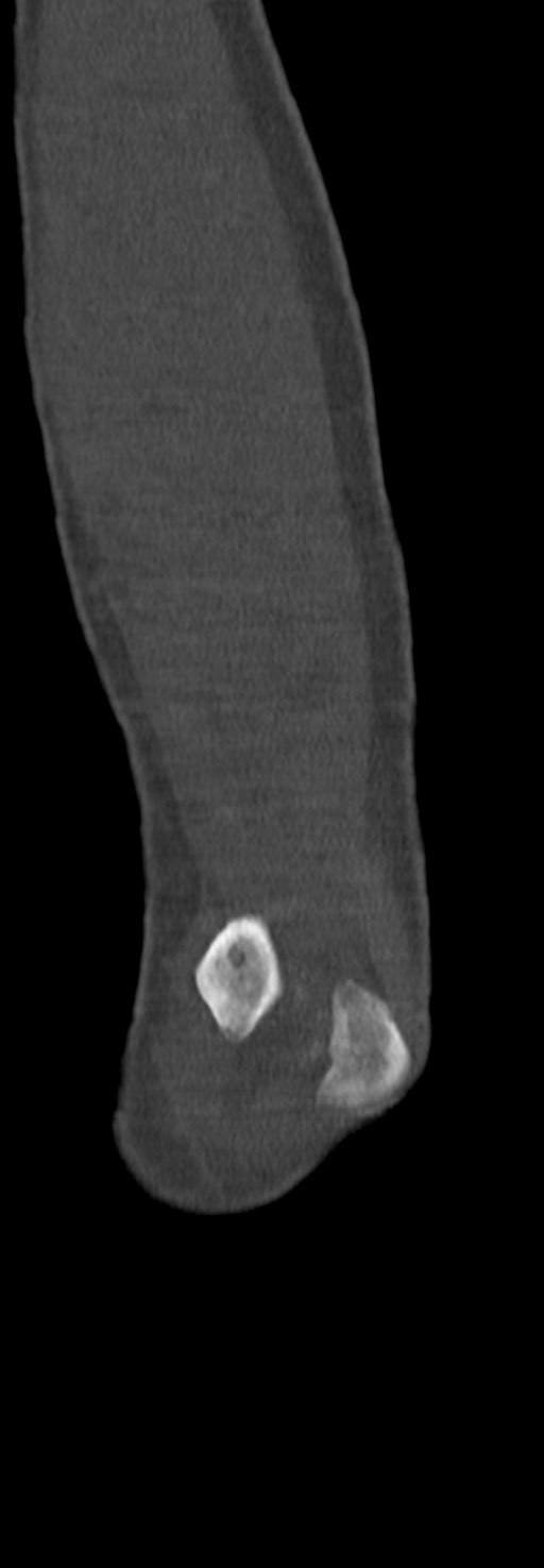 Chronic osteomyelitis of the distal humerus (Radiopaedia 78351-90971 Sagittal bone window 63).jpg