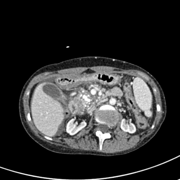 Chronic pancreatitis (Radiopaedia 55405-61846 A 41).jpg