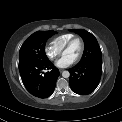 File:Chronic pulmonary embolus (Radiopaedia 39129-41341 Axial C+ CTPA 66).png