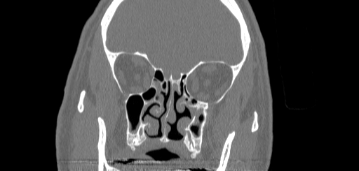 Chronic sphenoidal sinusitis (Radiopaedia 62030-70122 Coronal bone window 73).jpg