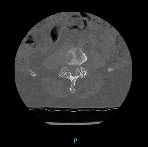 Chronic spinal hematoma with cauda equina syndrome (Radiopaedia 75745-88197 Axial bone window 40).png
