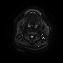 File:Chronic submandibular sialadenitis (Radiopaedia 61852-69885 Axial DWI 12).jpg
