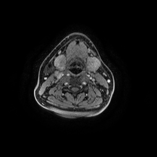 Chronic submandibular sialadenitis (Radiopaedia 61852-69885 Axial T1 C+ fat sat 46).jpg