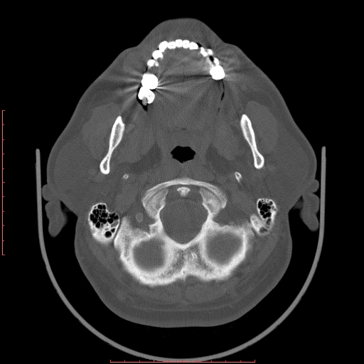 File:Chronic submandibular sialolithiasis (Radiopaedia 69817-79814 Axial bone window 18).jpg