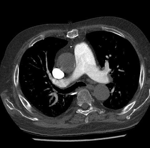 File:Chronic thromboembolic pulmonary disease (Radiopaedia 90694-108119 Axial C+ CTPA 40).jpg