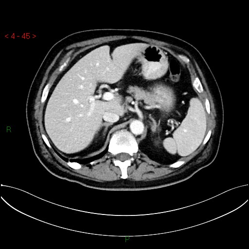 File:Circumaortic left renal vein and doubled left renal arteries (Radiopaedia 52268-58158 B 5).jpg