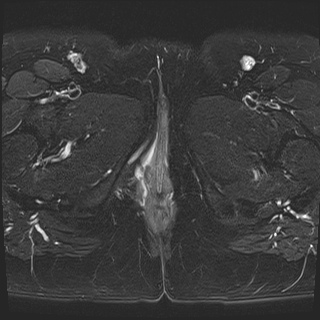 File:Class II Mullerian duct anomaly- unicornuate uterus with rudimentary horn and non-communicating cavity (Radiopaedia 39441-41755 Axial T2 fat sat 30).jpg