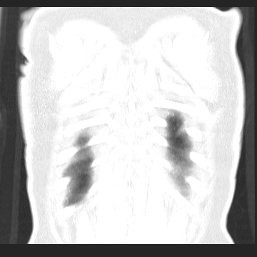 File:Classic complicated silicosis (Radiopaedia 49720-54961 Coronal lung window 60).jpg