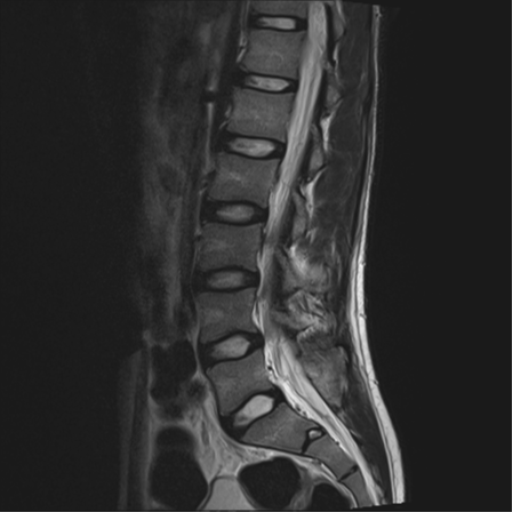 File:Clear cell meningoma - lumbar spine (Radiopaedia 60116-67690 Sagittal T2 10).png