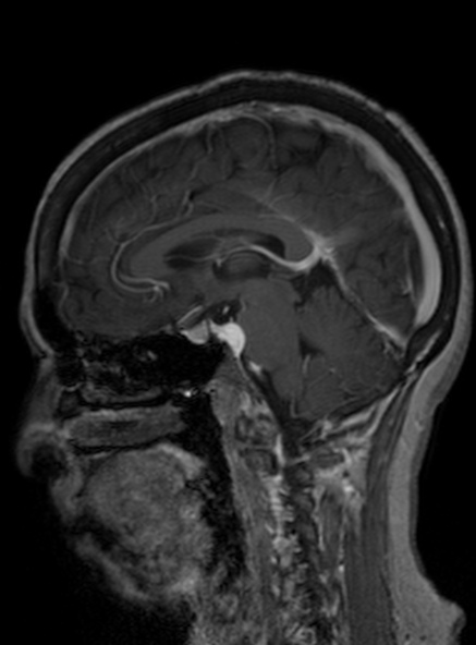Clival meningioma (Radiopaedia 53278-59248 Sagittal T1 C+ 264).jpg