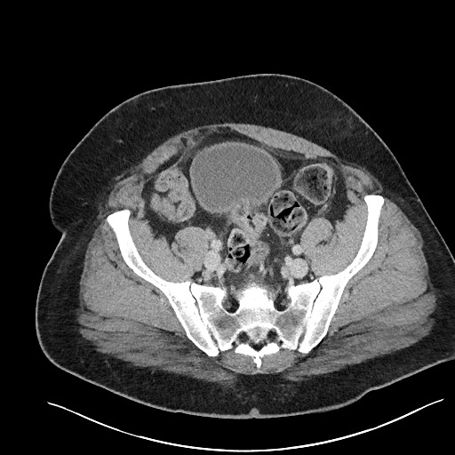 File:Closed loop obstruction - internal hernia into nephrectomy bed (Radiopaedia 59867-67320 A 112).jpg