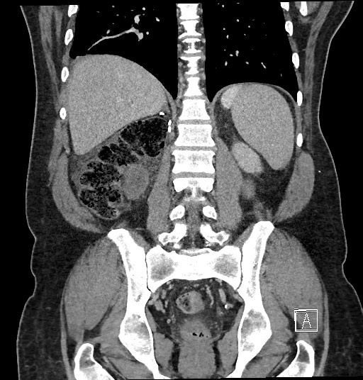 File:Closed loop obstruction - internal hernia into nephrectomy bed (Radiopaedia 59867-67320 B 99).jpg