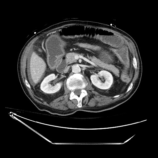 Closed loop obstruction due to adhesive band, resulting in small bowel ischemia and resection (Radiopaedia 83835-99023 D 60).jpg