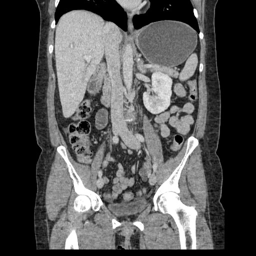 Closed loop small bowel obstruction (Radiopaedia 65403-74451 B 58).jpg