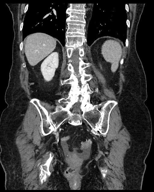 Closed loop small bowel obstruction - adhesions (Radiopaedia 59269-66611 B 92).jpg