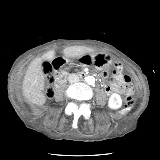 Closed loop small bowel obstruction - adhesions and infarct (Radiopaedia 85125-100678 B 50).jpg
