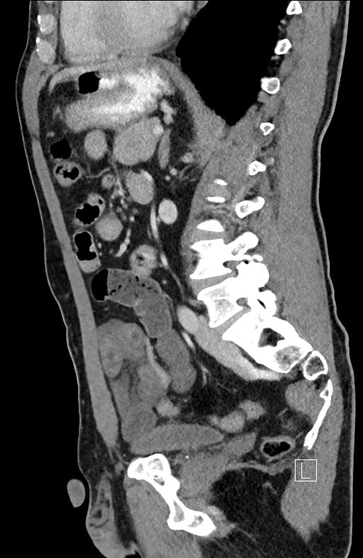 Closed loop small bowel obstruction - internal hernia (Radiopaedia 57806-64778 C 48).jpg