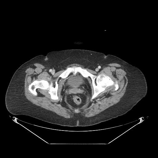 Closed loop small bowel obstruction - internal hernia (Radiopaedia 65402-74450 A 131).jpg