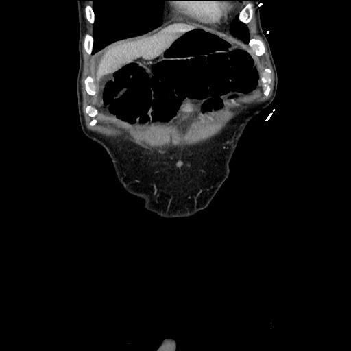 Closed loop small bowel obstruction - omental adhesion causing "internal hernia" (Radiopaedia 85129-100682 B 27).jpg