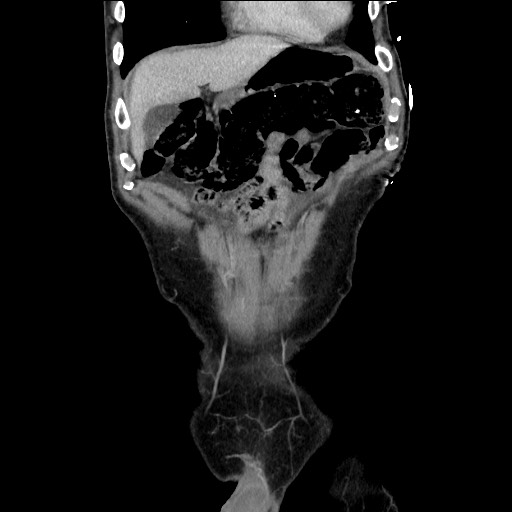Closed loop small bowel obstruction - omental adhesion causing "internal hernia" (Radiopaedia 85129-100682 B 33).jpg