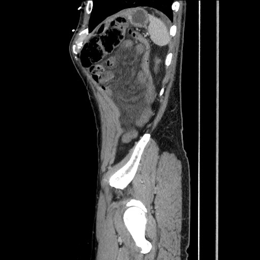 Closed loop small bowel obstruction - omental adhesion causing "internal hernia" (Radiopaedia 85129-100682 C 150).jpg
