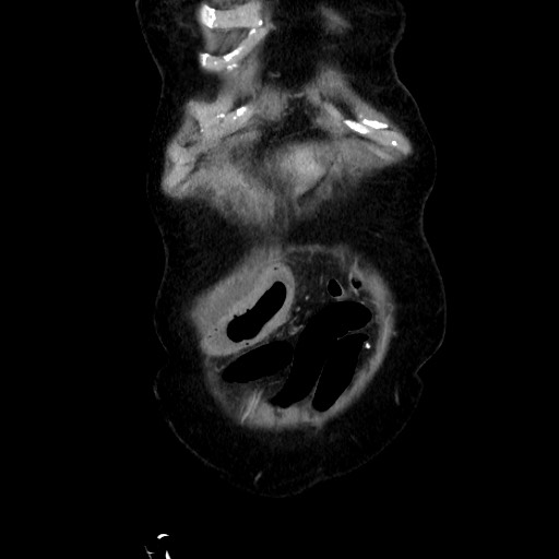 Closed loop small bowel obstruction due to adhesive band, with intramural hemorrhage and ischemia (Radiopaedia 83831-99017 C 20).jpg