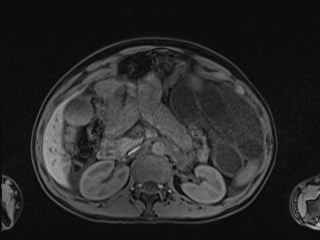 Closed loop small bowel obstruction in pregnancy (MRI) (Radiopaedia 87637-104031 Axial T1 fat sat 45).jpg