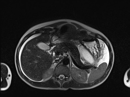 File:Closed loop small bowel obstruction in pregnancy (MRI) (Radiopaedia 87637-104031 Axial T2 19).jpg