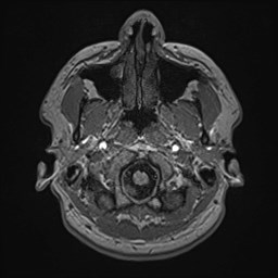 File:Cochlear incomplete partition type III associated with hypothalamic hamartoma (Radiopaedia 88756-105498 Axial T1 32).jpg